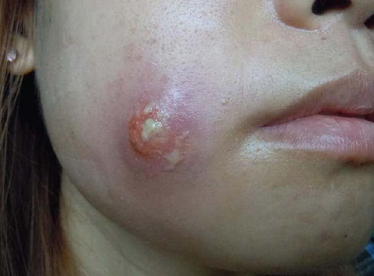 膿腫